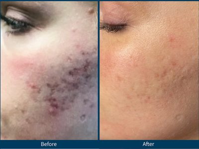 BA-Acne-Scar-4-treatment-2