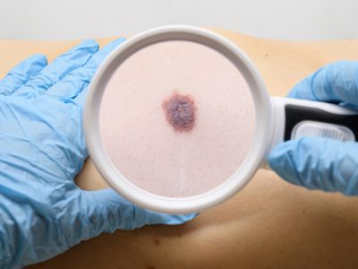 Melanoma